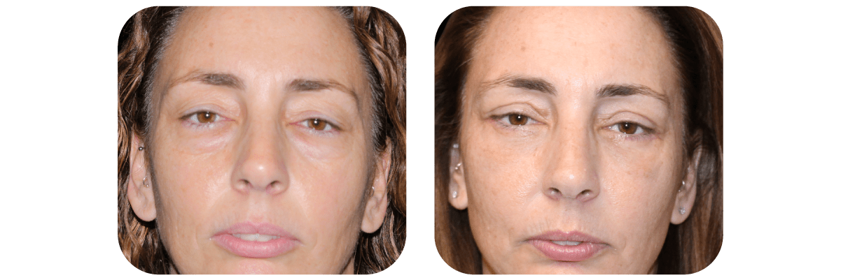 Blepharoplasty