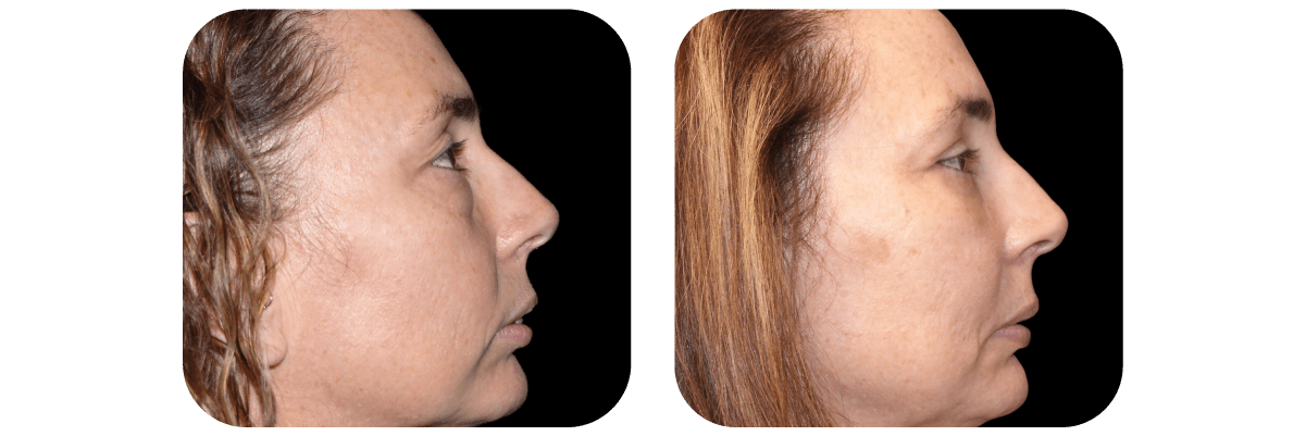 Blepharoplasty