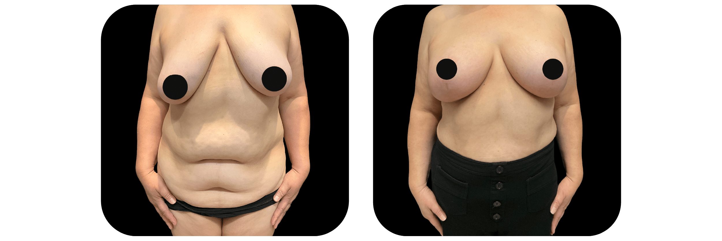 Breast Lift