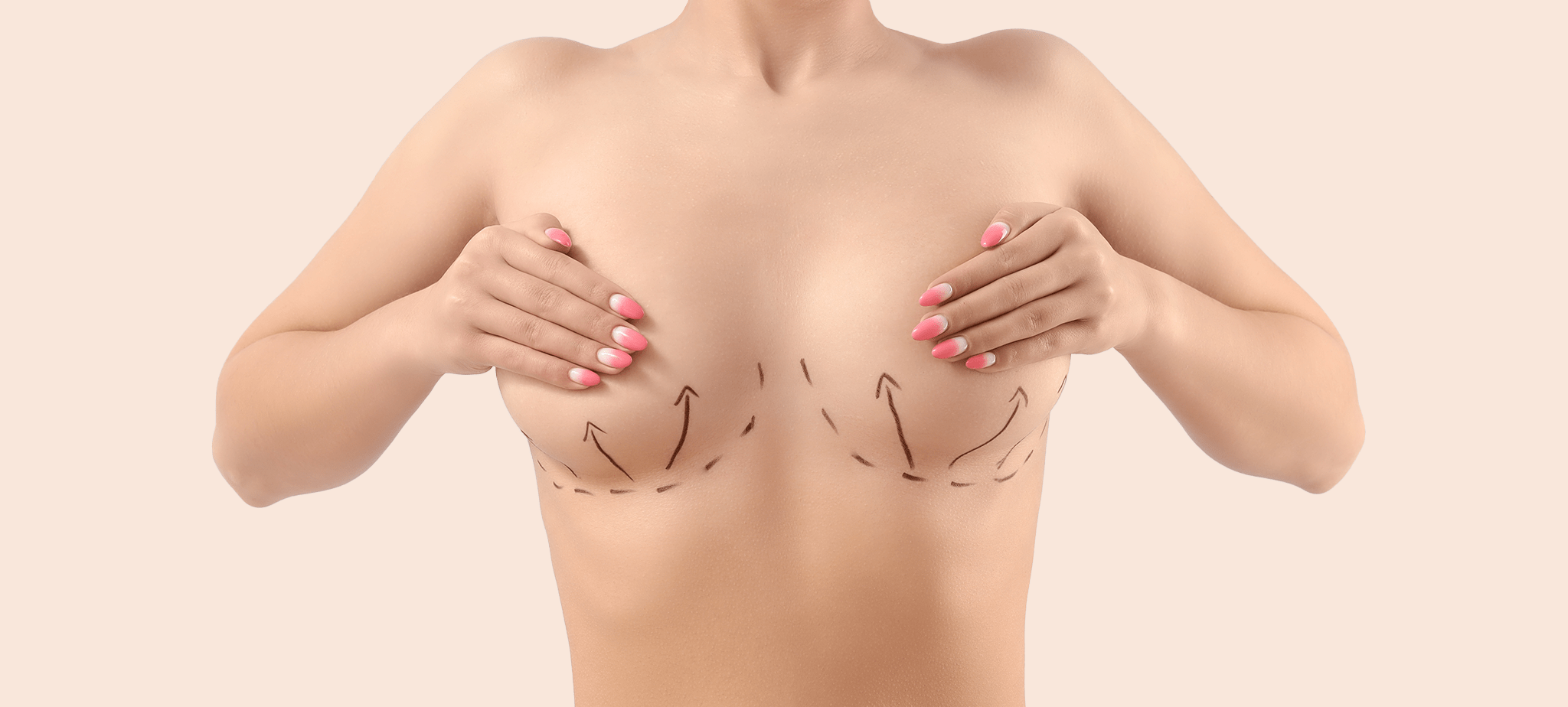 Breast lift