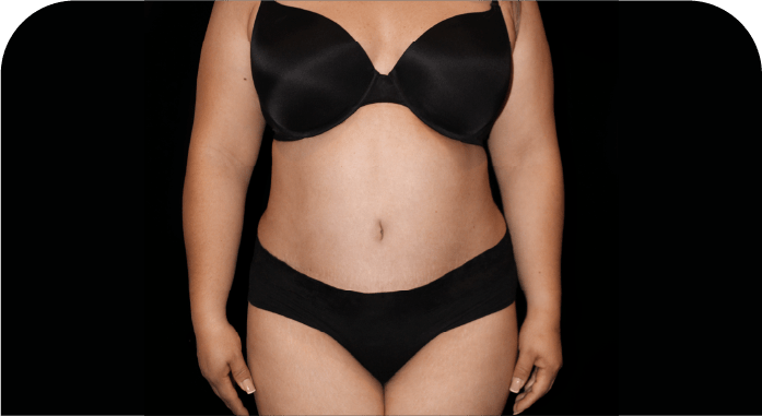 CARDS LIPOSUCTION 360 (1)