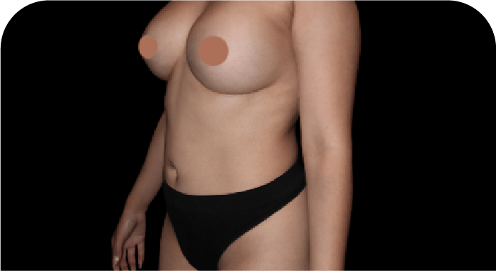 CARDS LIPOSUCTION