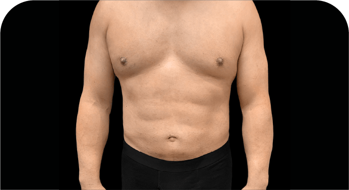 CARDS MARCACIÓN ABDOMINAL