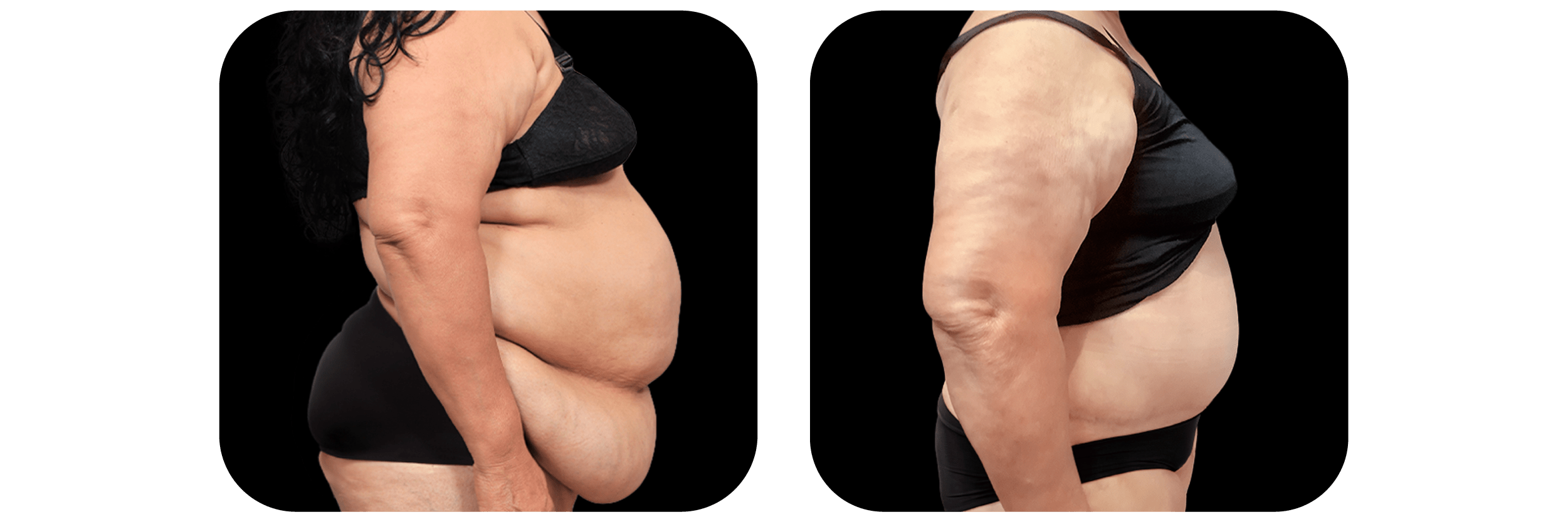Tummy Tuck