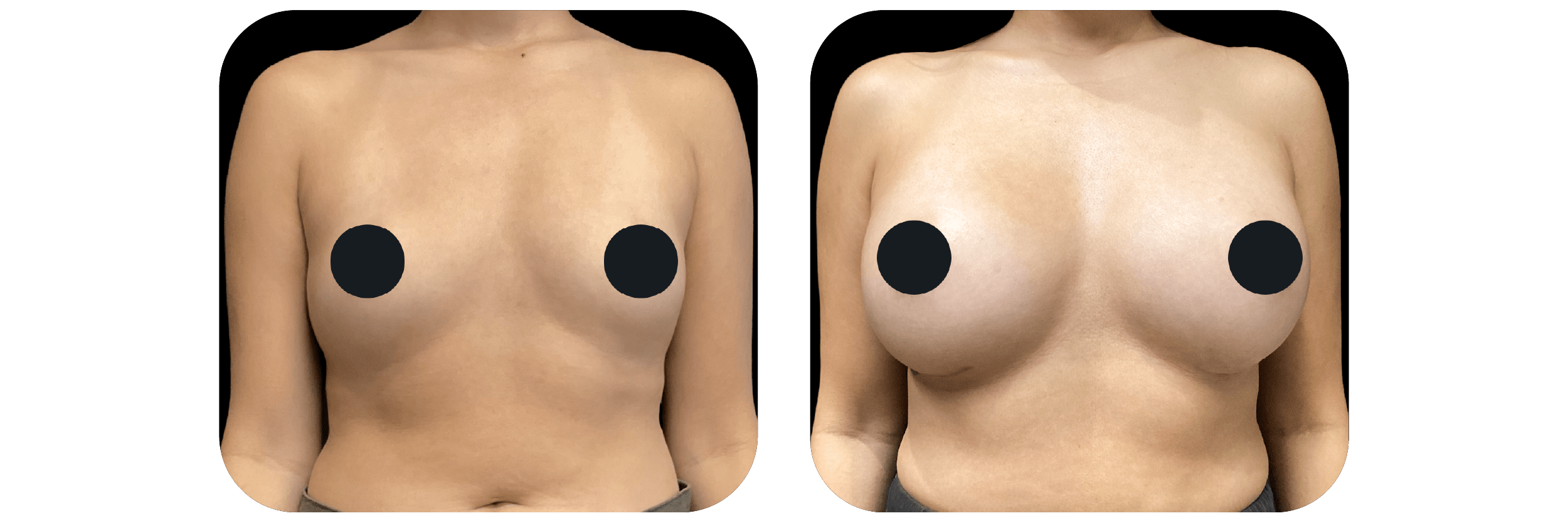 Before and after breast Ideal Plastic Surgery
