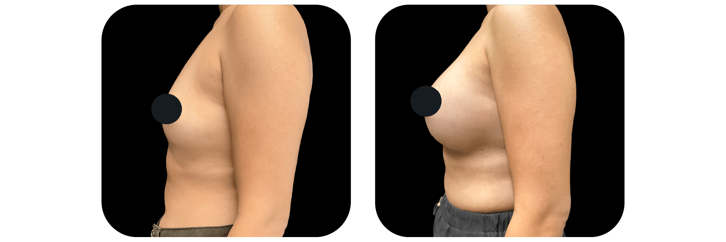 Before and after breast Ideal Plastic Surgery