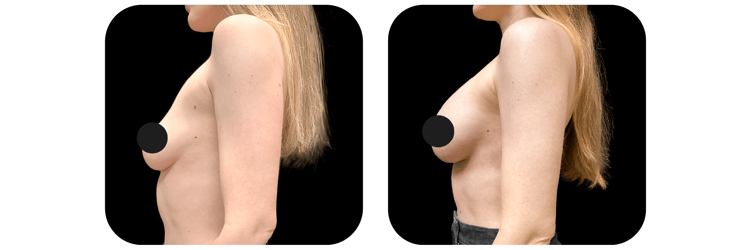 Before and after breast Ideal Plastic Surgery