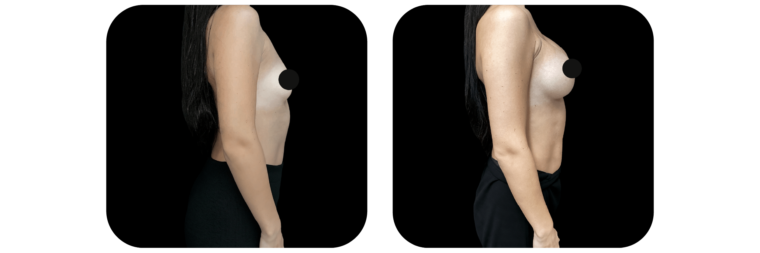 Before and after breast Ideal Plastic Surgery