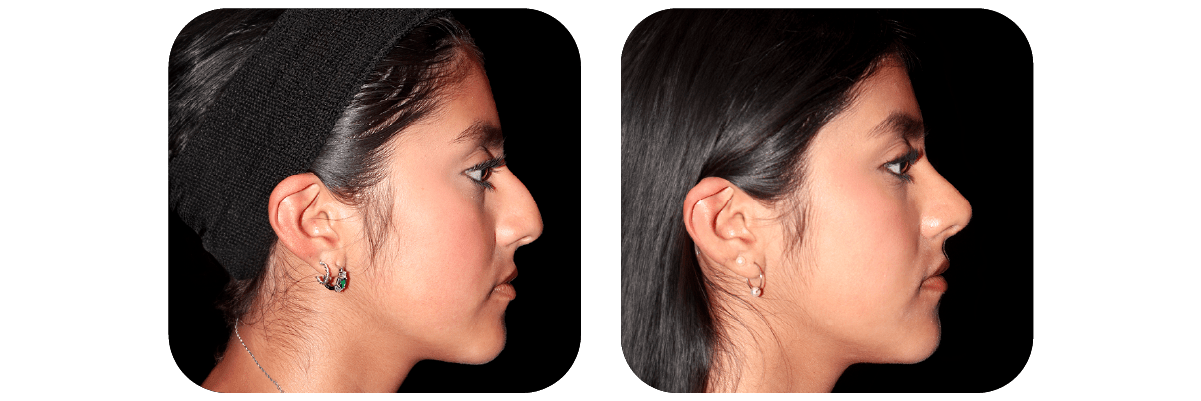 Rinoplastia