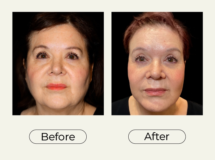 Necklift