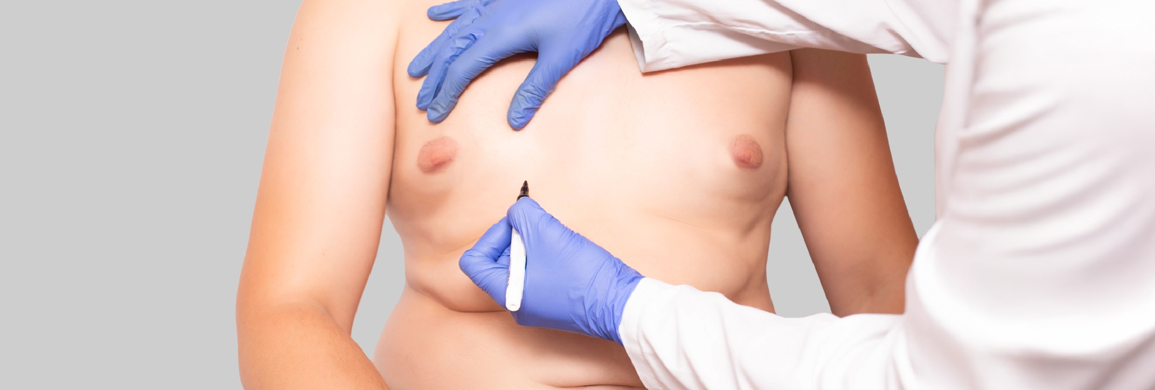 Gynecomastia