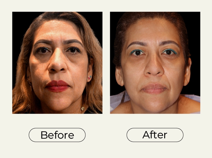 Blefaroplastia