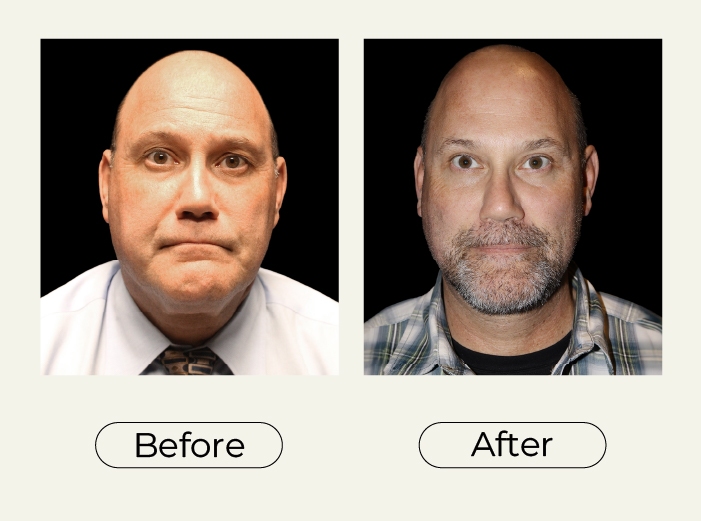 Blepharoplasty and Necklift