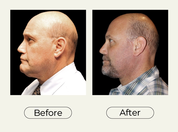 Blepharoplasty and Necklift