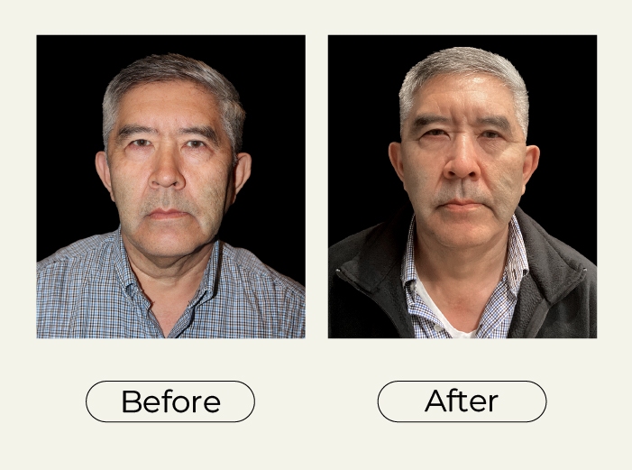 Necklift