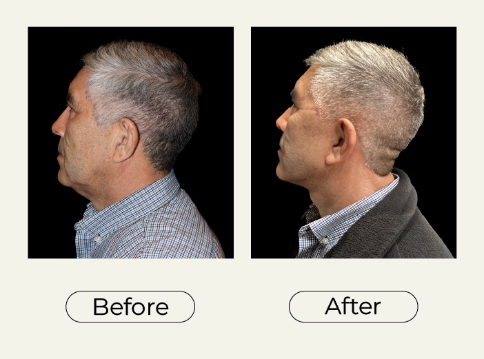 Necklift