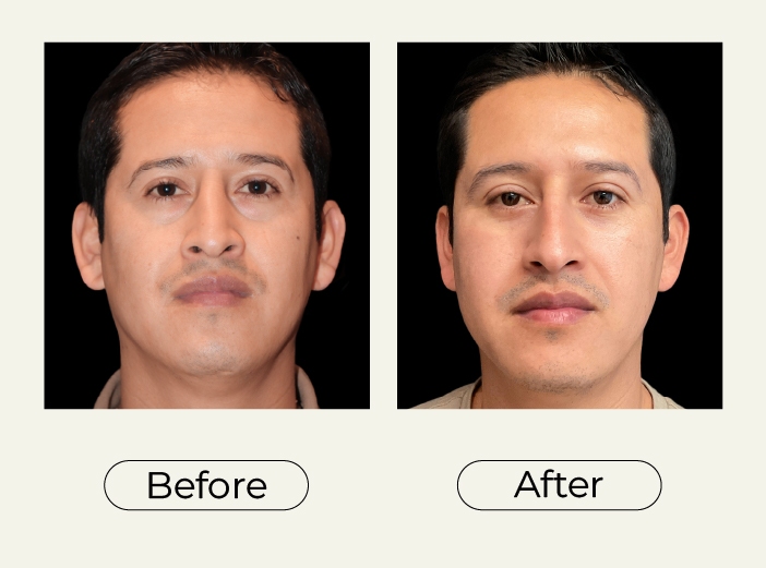 Blepharoplasty