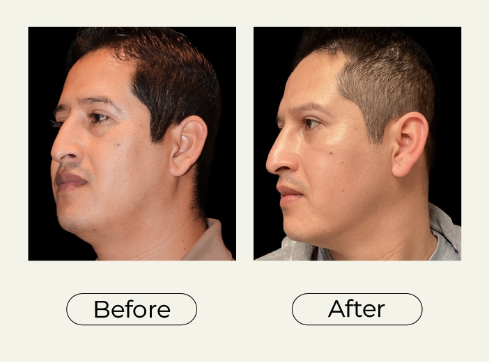 Blepharoplasty
