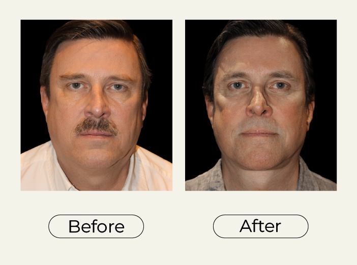 Necklift
