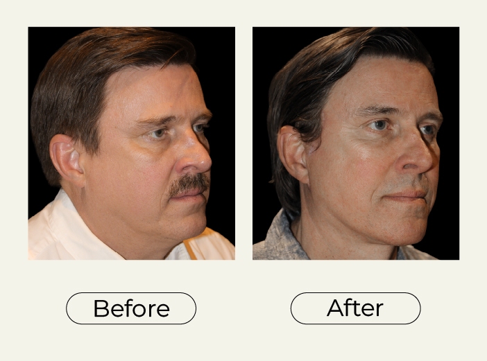 Necklift