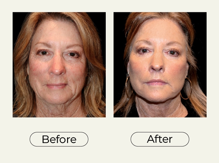 Facelift