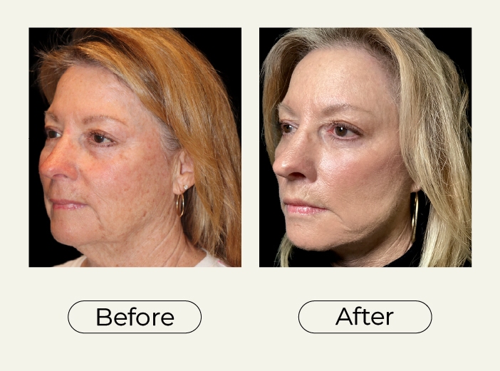 Facelift