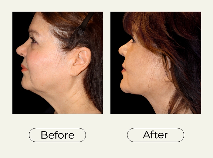 Necklift