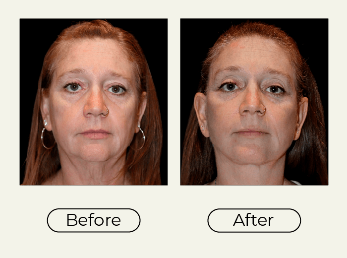 Side-by-side before and after photos of a woman's face, left labeled Before, right labeled After, showing cosmetic improvement and a more refreshed jawline after treatment.
