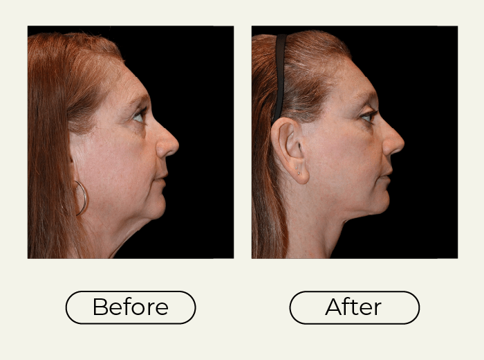 Side-by-side profile photos of a woman before and after cosmetic neck/face contouring, showing a slimmer jawline in the After image.