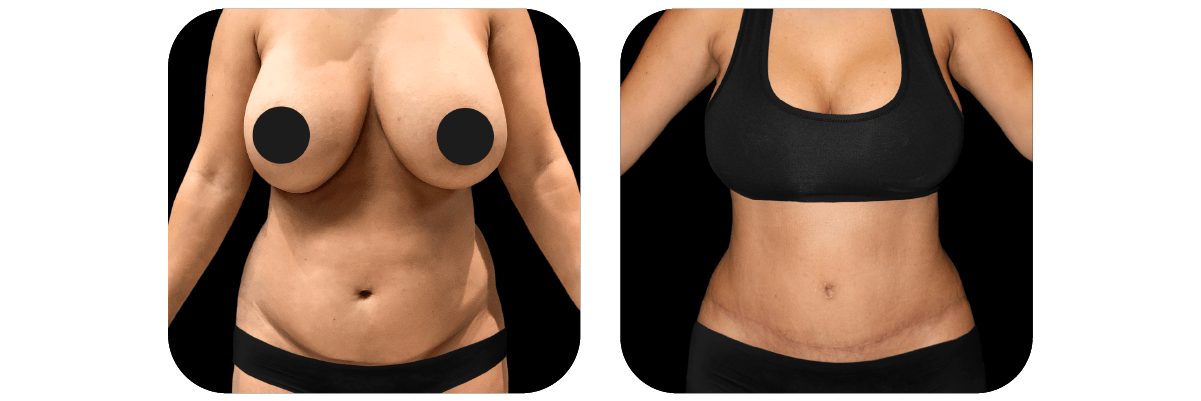 Tummy Tuck
