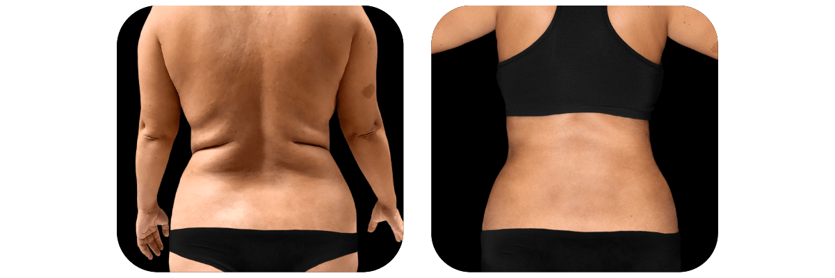 Tummy Tuck