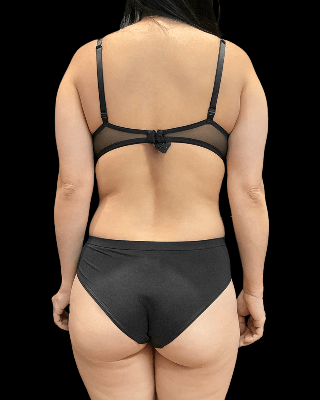 Before and after a BBL