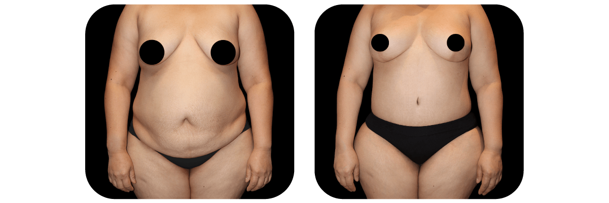Tummy Tuck
