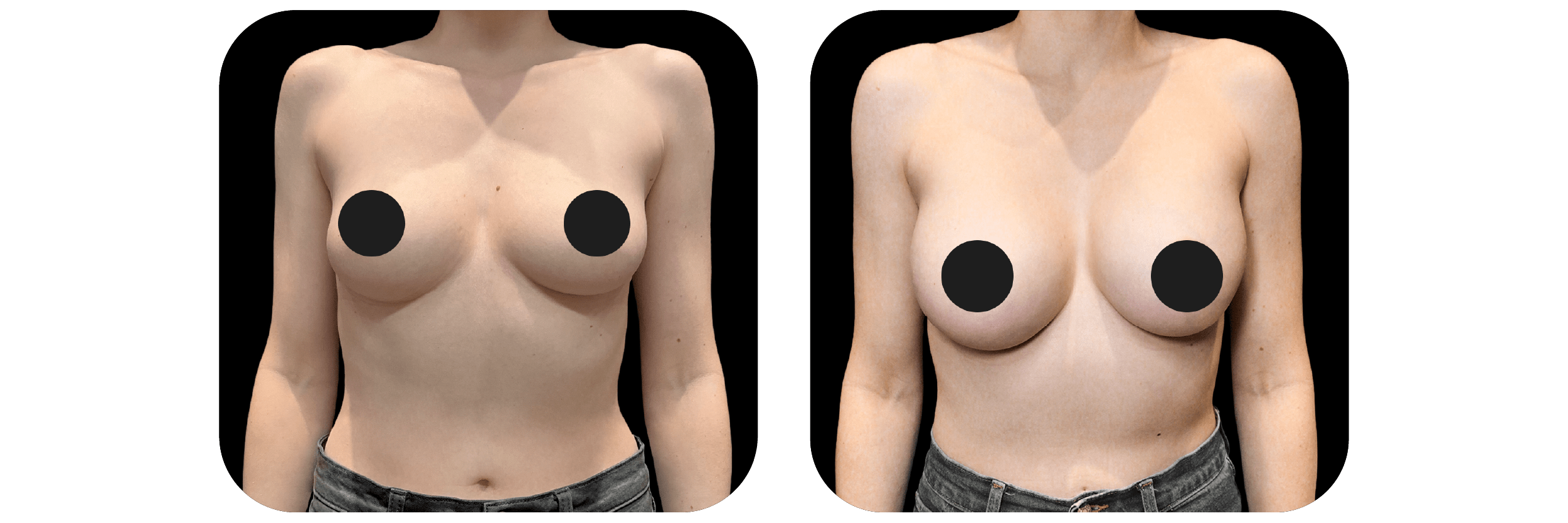 Before and after breast Ideal Plastic Surgery