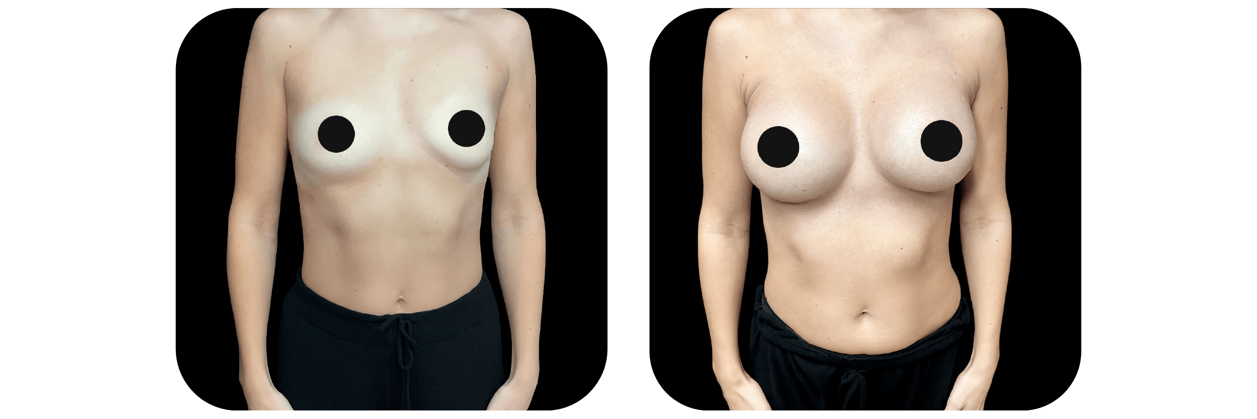 Before and after breast Ideal Plastic Surgery