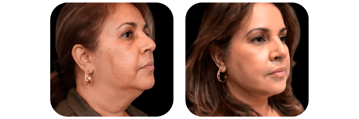 Necklift