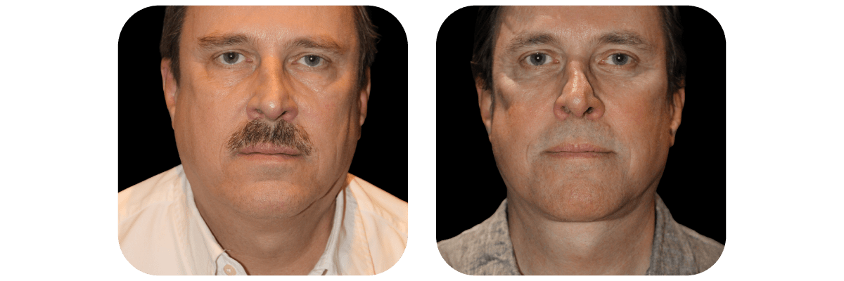 Necklift