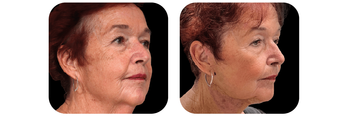 Necklift
