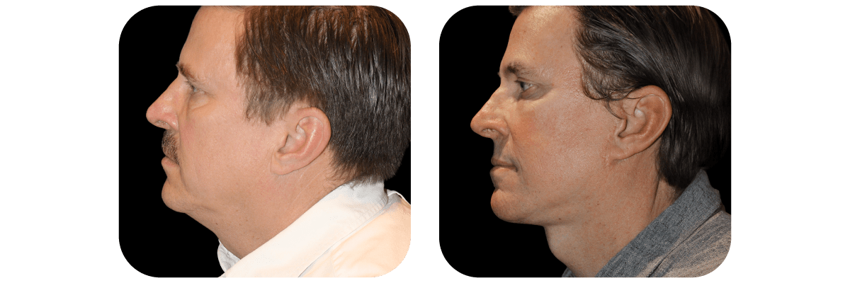 Necklift
