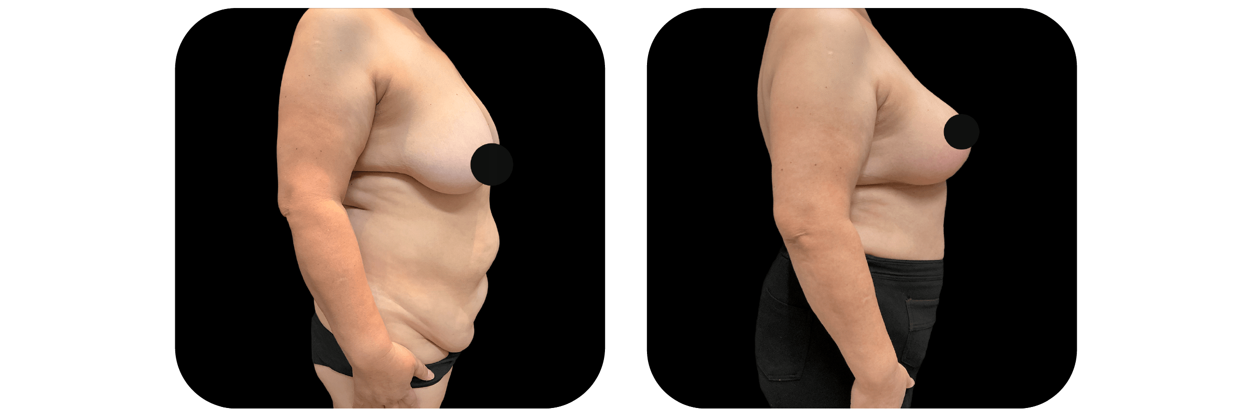 Breast Lift